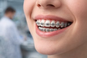 Металлические брекеты в Омске: особенности ортодонтического лечения и стоимость установки