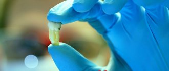Альвеолярный остит после удаления зуба