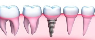 базальная имплантация зуба