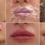 Чем мазать губы после увеличения гиалуроновой кислотой?