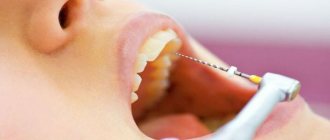 что такое депульпация зуба и как она проводится