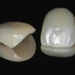 Циркониевые виниры на зубы
