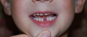 Дети часто глотают выпавшие молочные зубы