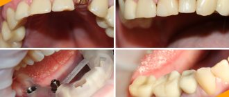 Фото до и после одномоментной имплантации зубов