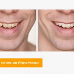 Фото мужчины до и после лечения брекетами