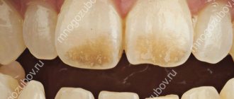 Фото: Пигментация зубов у пациента