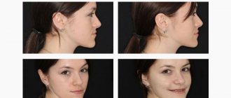 Фото пропорций лица пациентки до и после лечения