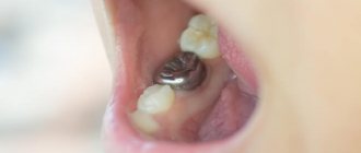 Фото зубной коронки во рту у ребенка
