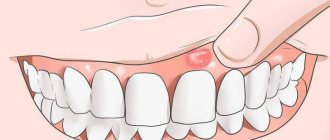 Гель стоматологический Холисал - отзывы