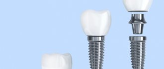 Имплантация одного зуба