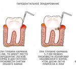 измерение пародонтальных карманов