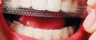 как действуют и какие бывают полоски для отбеливания зубов Crest Whitestrips, отзывы о них