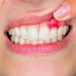 Киста зуба - симптомы, лечение