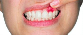 Киста зуба - симптомы, лечение