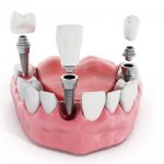 Конструкции зубных имплантов - Стоматология «Линия Улыбки»