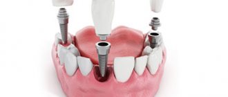 Конструкции зубных имплантов - Стоматология «Линия Улыбки»