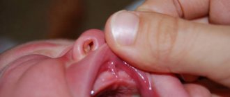 Короткая уздечка верхней губы у новорожденного