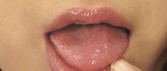 Кожа языка становится очень чувствительной - Стоматология «Линия Улыбки»