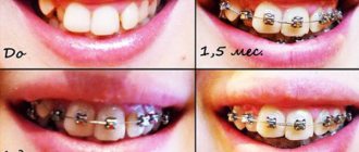 металлические брекеты на зубах