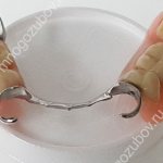 Металлические зубные протезы