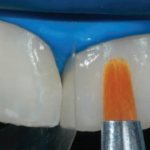 Методы лечения слившихся зубов