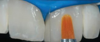 Методы лечения слившихся зубов
