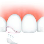 Можно ли восстанавливать передние зубы пломбами?