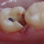 Мышьяковая паста в зубе