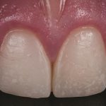 Новая классификация керамических материалов в стоматологии: как сделать правильный выбор?