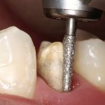 обточка зуба