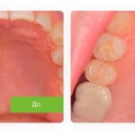 одномоментная имплантация жевательного зуба
