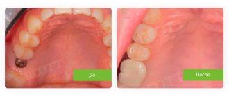 одномоментная имплантация жевательного зуба