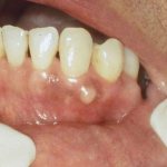 осложнения при развитии кисты зуба под коронкой