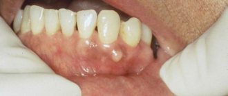осложнения при развитии кисты зуба под коронкой