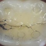 Особенности трещин зубной эмали