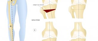 Остеотомия коленного сустава