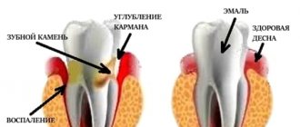 Периодонтит зуба: что это такое — симптомы и как его лечить, Северо-Восточный Стоматологический Центр №1