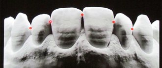 Правила пломбирования с сохранением контактного пункта зуба