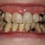 Пришеечный кариес на верхних зубах
