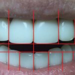 Процедура реставрации зубов
