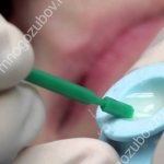 Проведение глубокого фторирования зубов