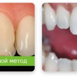 прямой и непрямой метод реставрации зубов