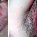 симптомы сифилиса на половых губах