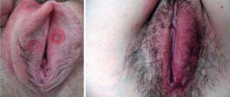 симптомы сифилиса на половых губах