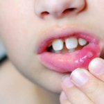 У детей лечить стоматит и иные патологии полости рта сложнее