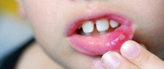 У детей лечить стоматит и иные патологии полости рта сложнее