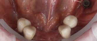 У пациента на нижней челюсти имелось всего 4 зуба, воспалительные процессы в области ранее установленных имплантов