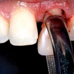 удаление переднего зуба