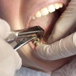 'Удаление разрушенного зуба - Стоматология "Линия Улыбки"' width= "400