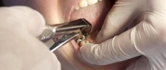 'Удаление разрушенного зуба - Стоматология "Линия Улыбки"' width= "400